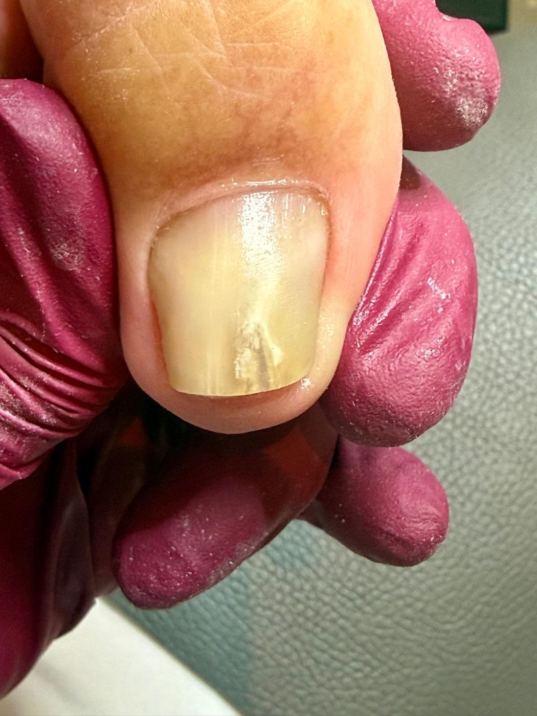 podo-beauty.at Nagelprothetik bei gespaltenem Zehennagel in Wien 1140 – nachher