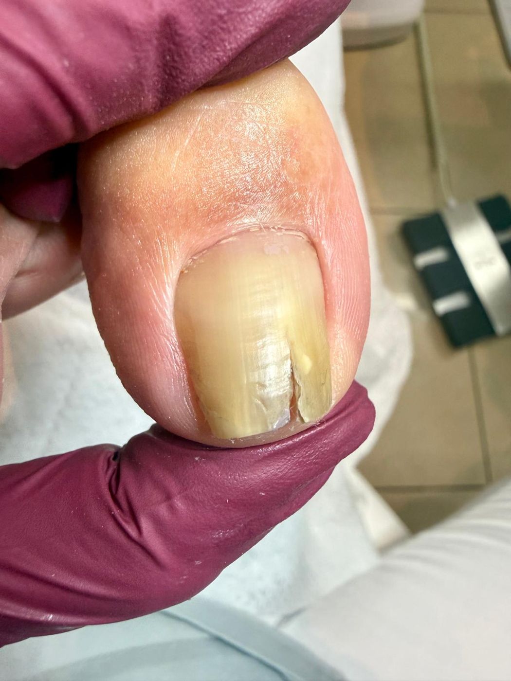 podo-beauty.at Nagelprothetik bei gespaltenem Zehennagel in Wien 1140 – vorher